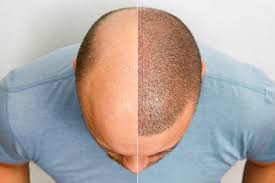 Hair Transplant Procedure