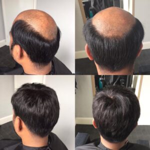 Hair Patch